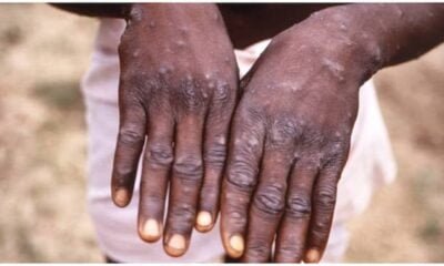 Monkeypox: Ghana Records 5 Cases In 3 Regions