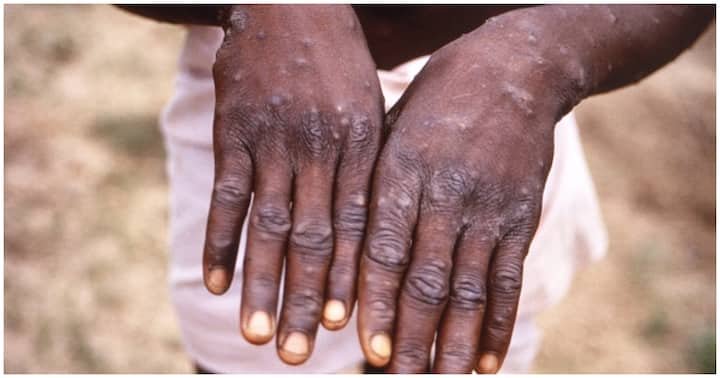 Monkeypox: Ghana Records 5 Cases In 3 Regions