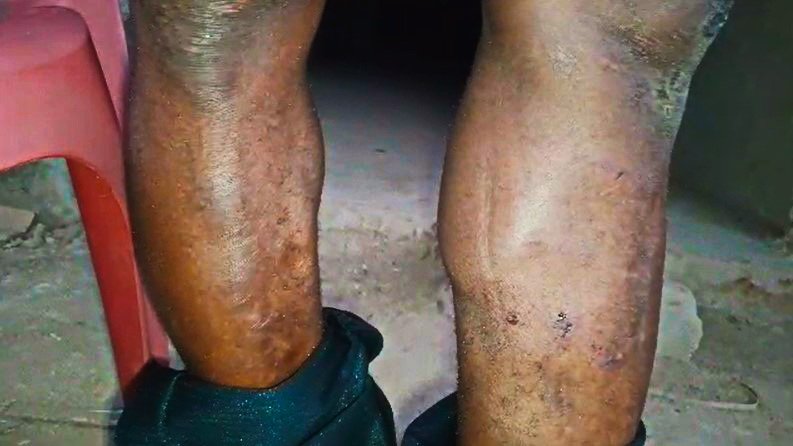 Assemblyman Claims NDC Thugs Tortured Him on Regional Chairman’s Orders