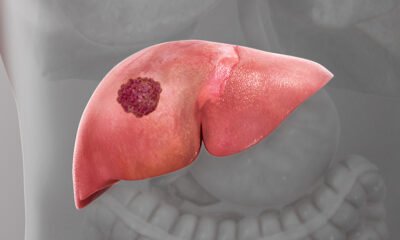 Liver Cancer Hits Hard in Ghana: 90% Mortality Rate Recorded in 2022