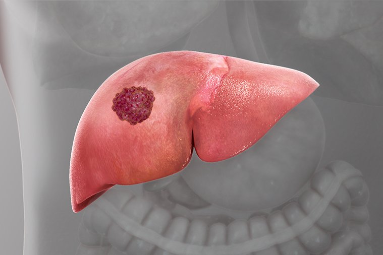 Liver Cancer Hits Hard in Ghana: 90% Mortality Rate Recorded in 2022