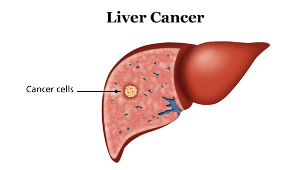 Liver Cancer Hits Hard in Ghana: 90% Mortality Rate Recorded in 2022